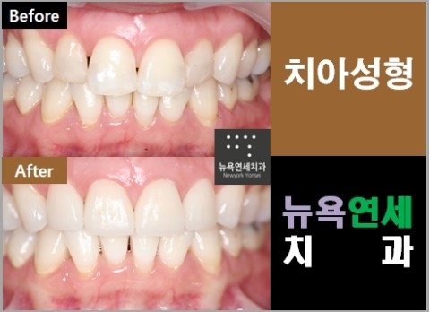  [앞니치아성형] 10일 완성하는 앞니치아성형 잘하는 치과 