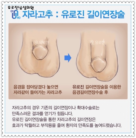 자라고추수술 얼마나 길어지나요?