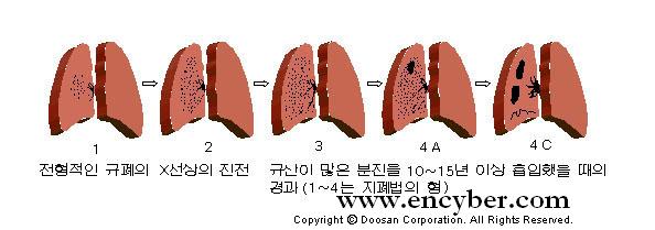  진폐증·폐암 등 환경성질환, 삼척 주민 가장 많이 앓아