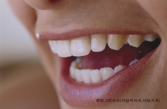 야탑역치과추천 착색된 치아미백으로 개선한 케이스 2