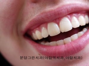 야탑역치과추천 착색된 치아미백으로 개선한 케이스