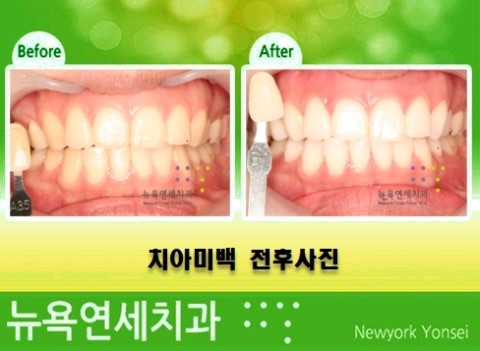  [치아미백 잘하는곳] 치아미백 후 터치업미백 관리