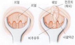 항문찢어져 항문이 아픈데 마데카솔 발라도 될까