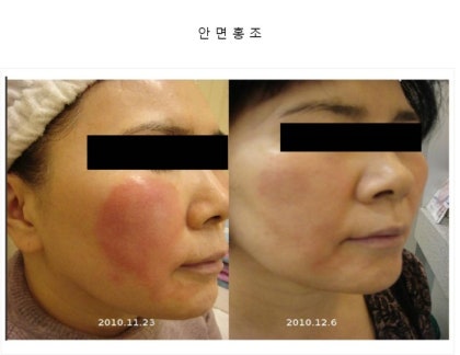 Gwangmyong 여드름 플러시 문제 관리 Angela Beauty Gwangmyong 여드름 플러시 문제 관리 Angela Beauty