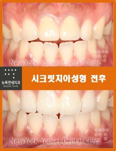 라미네이트 * 라미네이트사례-----앞니라미네이트