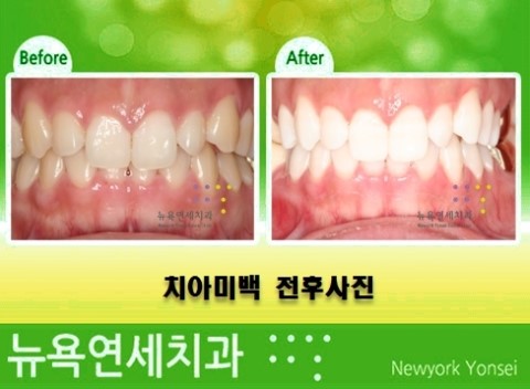  치아미백치과 연예인치아미백 알아보기 * 치아미백가격 & 치아미백비용 은?