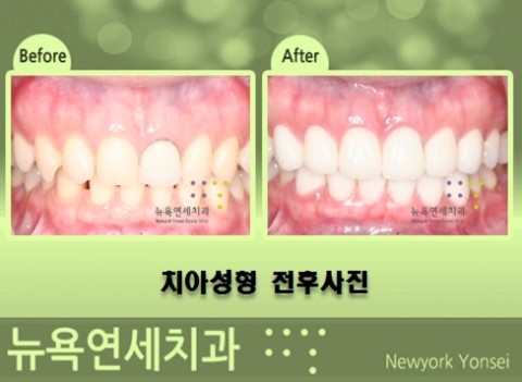  라미네이트가격 * 라미네이트비용-----앞니라미네이트치과