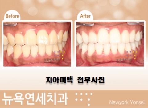  [원데이 치아미백] 전문가 치아미백 + 자가 치아미백 시술 전후사진