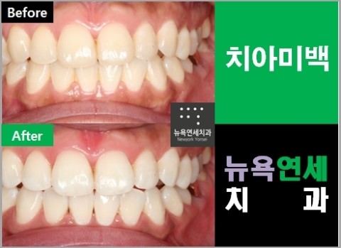  [치아미백종류] 전문가 치아미백종류*치아미백전후사진