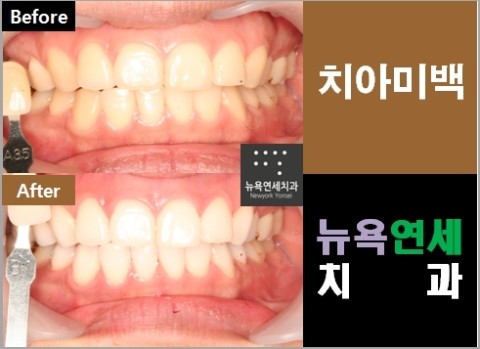 [치아미백] 스탠다드 치아미백 전후 사진입니다. 