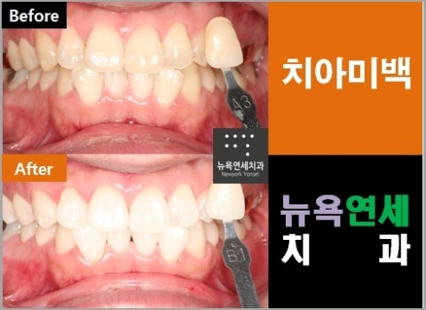  [치아미백종류] 연예인치아미백 전후 사진