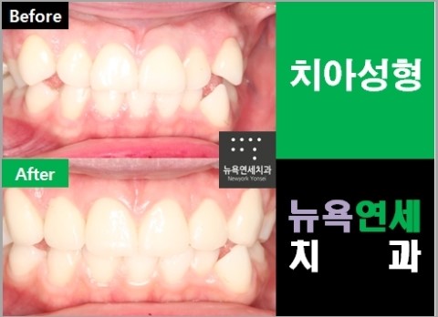  #.앞니성형치과 치아성형잘하는곳은?*