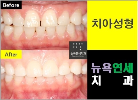  [라미네이트종류] 앞니라미네이트 가격?