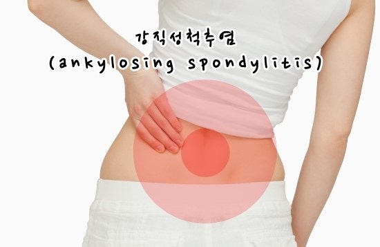 강직성척추염 장애등급