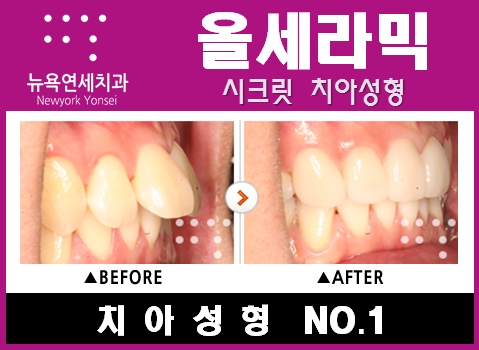  [앞니치아성형] 올세라믹을 이용한 앞니치아성형