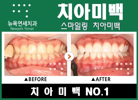  강남역치아미백  전문가치아미백