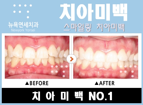  원데이치아미백 하루에 끝나는 원데이치아미백 전후사진