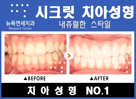  치아성형전문치과긴앞니치아성형__앞니라미네이트