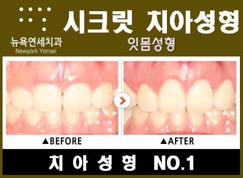  [잇몸성형]  잇몸라인으로 아름다운 미소를 완성하세요