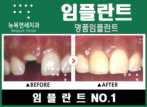 [임플란트종류] 맞춤형 임플란트 프로그램으로 상실된 치아를 되찾으세요