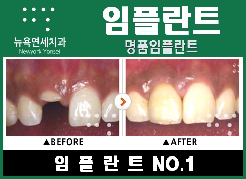  [임플란트종류] 맞춤형 임플란트 프로그램으로 상실된 치아를 되찾으세요