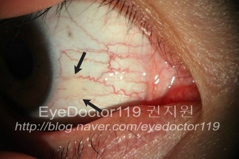 검열반 절제술 시술전후 사진입니다.