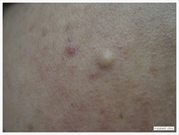 표피낭종(Epidermal cyst)의 임상 소견﻿ : 네이버 블로그