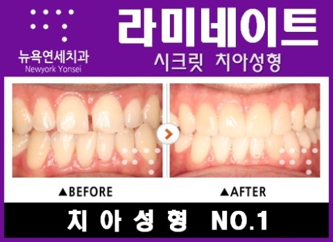  [앞니라미네이트] 벌어진앞니라미네이트 * 치아성형치과