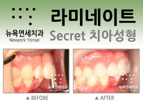  앞니가 고민이라면 치아성형으로 해결하세요.