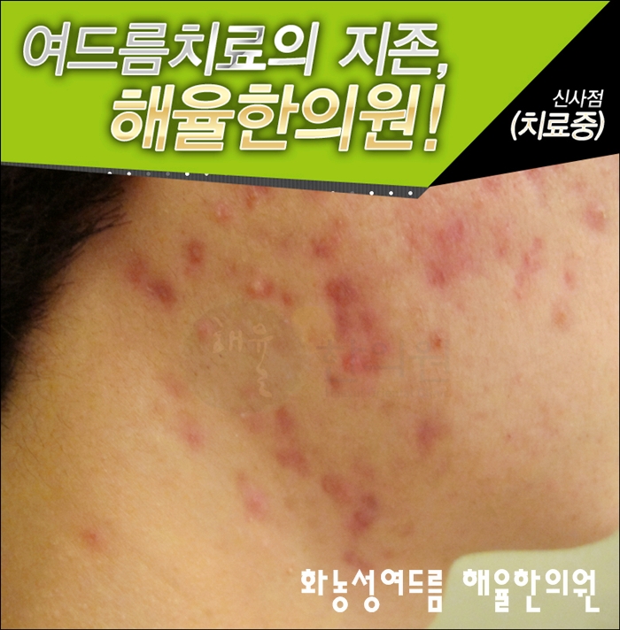 화농성 여드름의 원인을 이렇게 해결