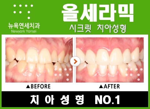  [앞니치아성형잘하는곳] 올세라믹으로 앞니치아성형 시술 한 치아성형 전후사진
