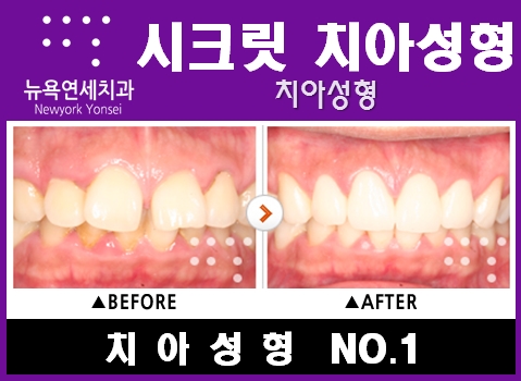  [치아성형종류] 벌어진치아 치아성형으로 해결하세요