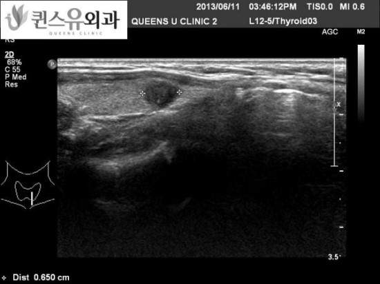 대구 갑상선병원, 대구 갑상선 초음파, 갑상선암 림프 전이에 대해 알아보도록 하겠습니다. - a21