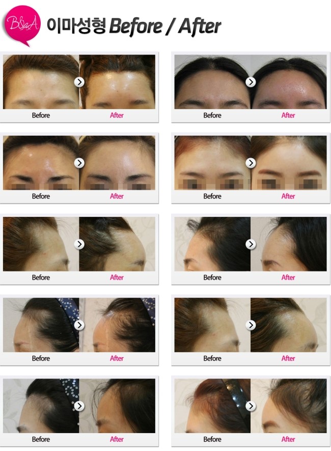 액자보형물 회복기간 상쾌하게