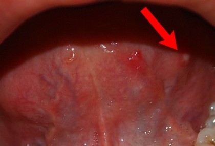 아프타성 구내염 설염 재발 - 혀와 혀밑 구강점막에 구내염과 설염이 자주 생겨요 : 네이버 블로그