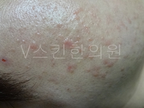 얼굴 좁쌀 두드러기 말끔한 제거법
