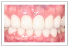 [타입별 치아성형] 큐티스타일의 치아성형으로 어려보이는 앞니 치아성형하기
