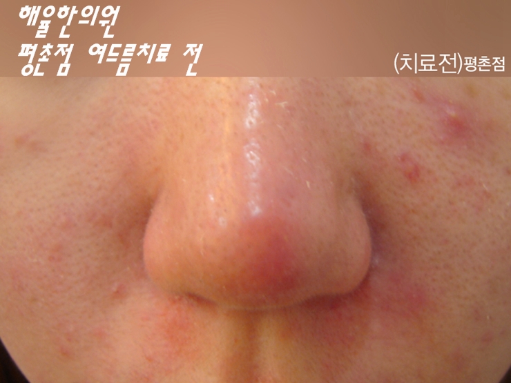 코여드름(코옆,콧속,코여드름) 여드름의 원인과 지우는 방법