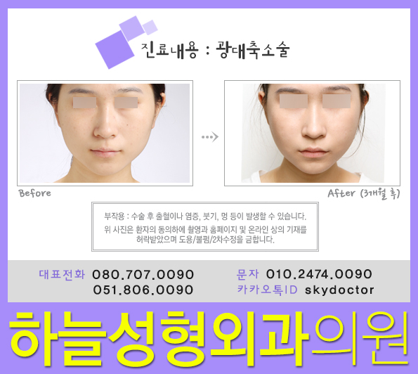 부산광대수술 잘하는곳 이곳인가요 5