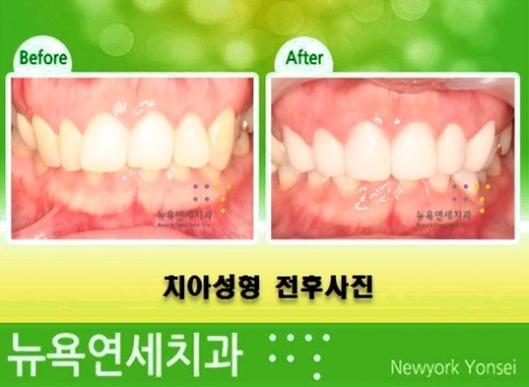  [유형별 치아성형] 치아 유형별 치아성형 사례 분석 입니다.