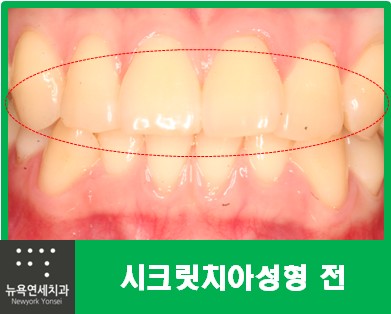  [돌출앞니 라미네이트시술] 돌출앞니+크기가 다른앞니를 라미네이트 치아성형
