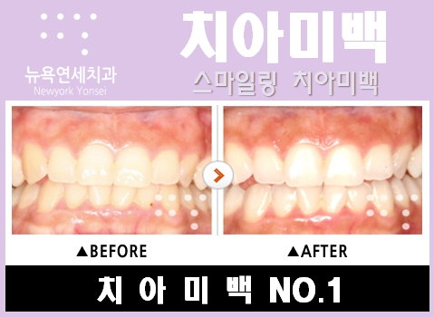  [블링블링 미백데이] 원데이치아미백을 미백데이로 나만의 이벤트!