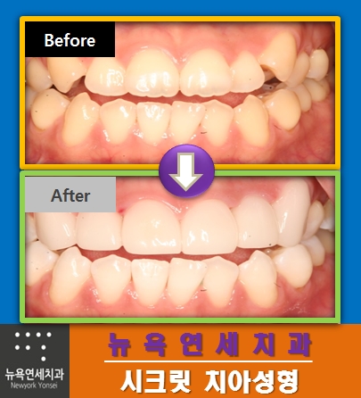 [시크릿 앞니성형] 치아성형+잇몸성형+치아미백으로 시크릿치아성형 하기