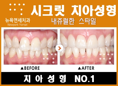  [내츄럴스타일 치아성형] 자연스러운 앞니 치아성형으로 스타일을 만든다.