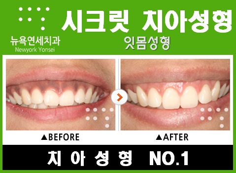  [잇몸과다노출_거미스마일] 잇몸성형으로 거미스마일 개선한다.