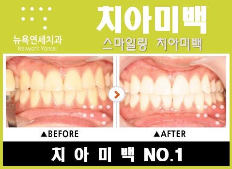  [연예인 치아미백] 연예인이 많이 하는 스탠다드치아미백 방법