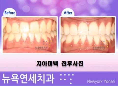  [강남역 치과이벤트] 원데이치아미백 이벤트로 치아미백을 저렴하게~!