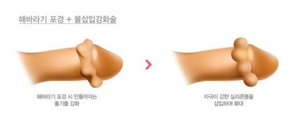 남성 해바라기 해바라기 포경수술