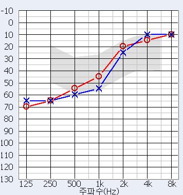  역경사형 난청(Reverse slope type) - 안산보청기