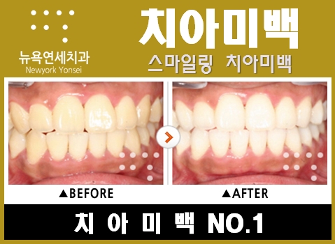 치아필링으로 치아미백 효과를 높인다.